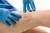 Varicose Veins